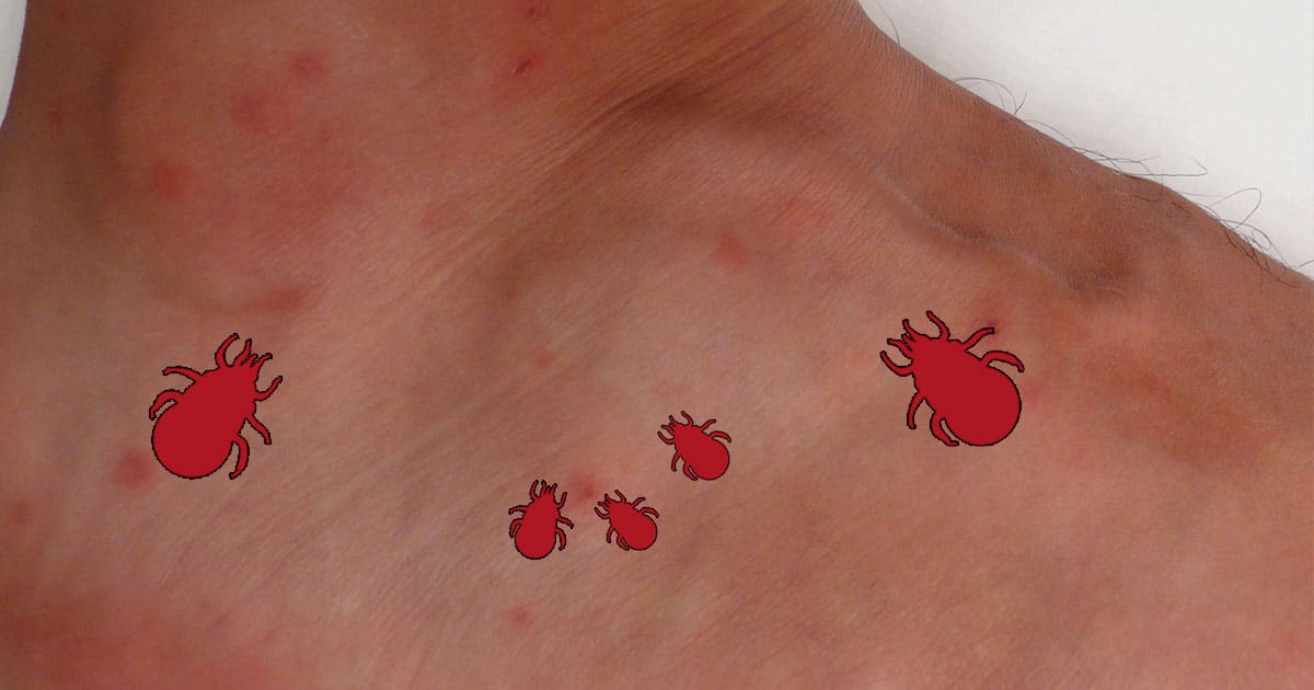 Poux rouges sur l'homme : quels dangers et comment s'en débarrasser ?