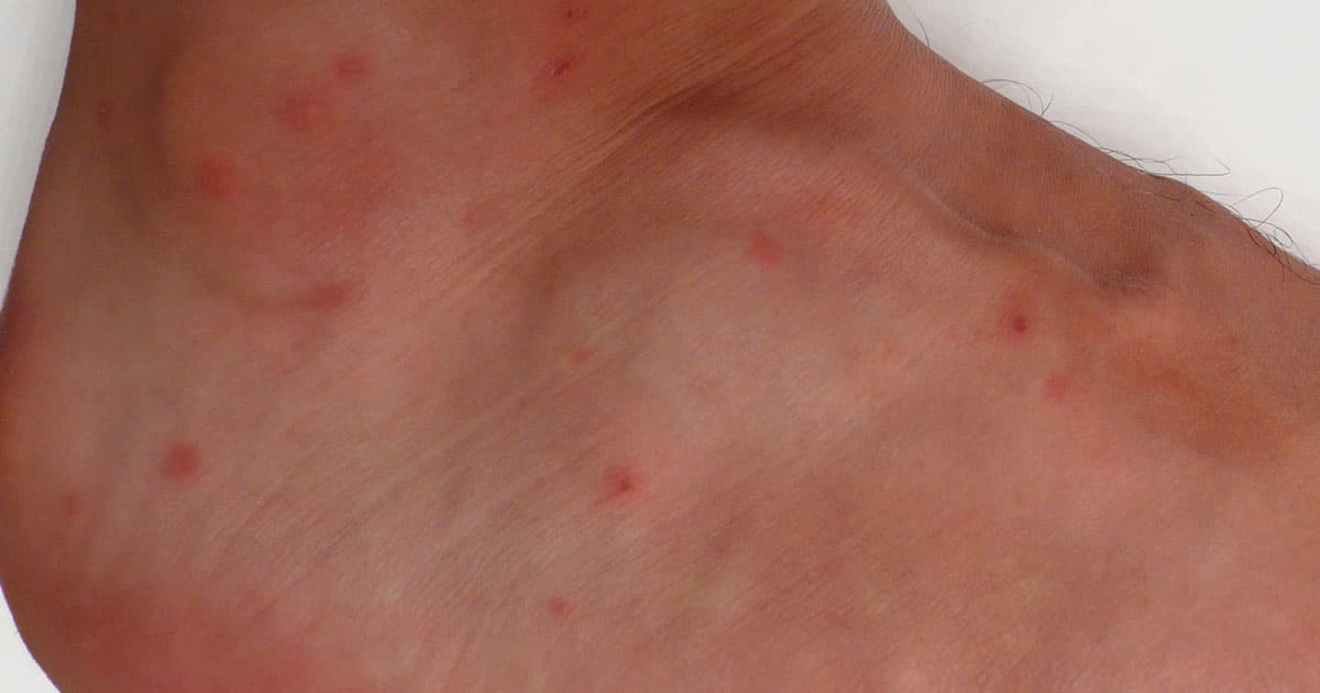 Exemple de piqure de poux rouges sur l'homme